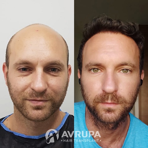 Male Hair Transplant in Turkey