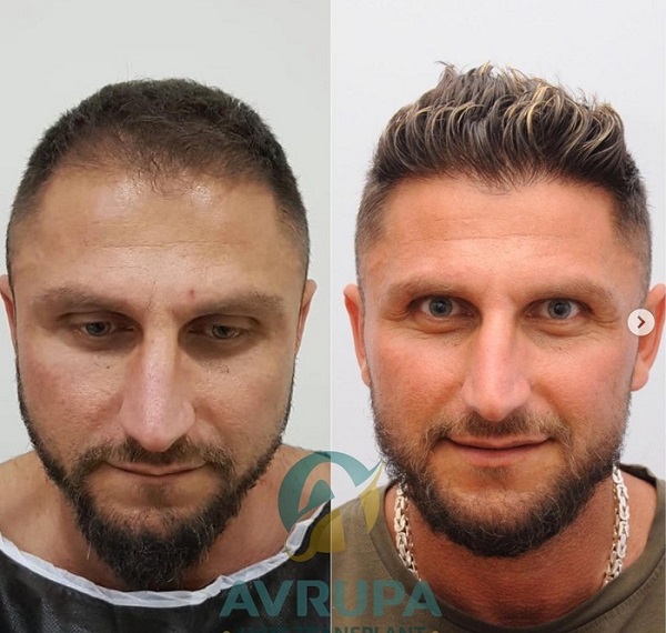 Male hair transplant in Turkey