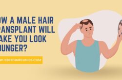 Male Hair Transplant in Turkey and How it Can Make You Look Younger?